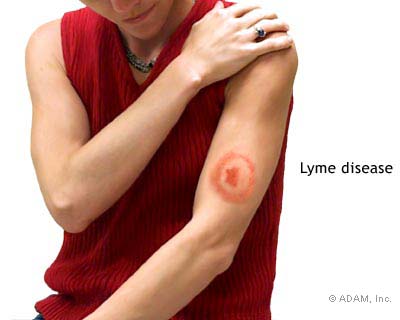 Lyme-kór eredetű ízületi gyulladás, vagy arthritisz?